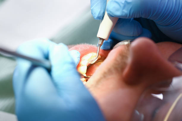 Best Emergency Tooth Extraction in Barron, WI
